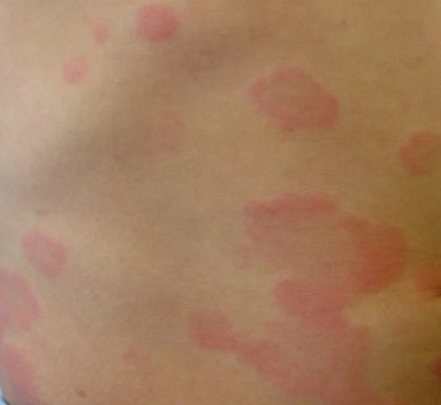 Patient with a severe outbreak of chronic urticaria on the back, exhibiting red welts and scratching due to itching. Urgent consultation with an allergist is required.