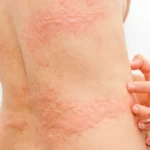 Patient with a severe outbreak of chronic urticaria on the back, exhibiting red welts and scratching due to itching. Urgent consultation with an allergist is required.